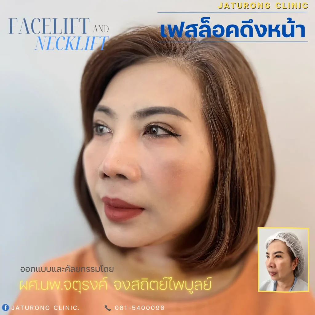 Jaturong ดึงหน้า 2 จุด 2 (Web H)