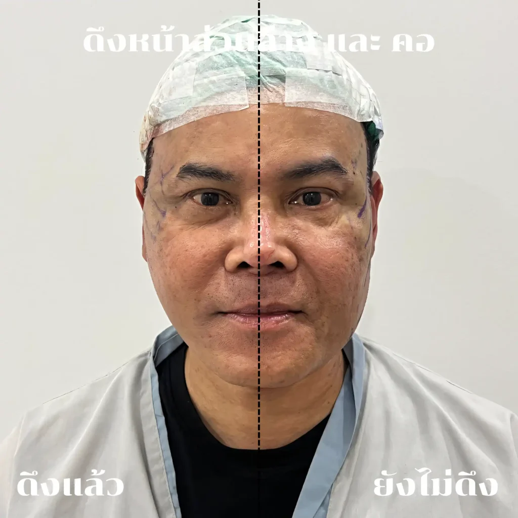 Jaturong ดึงหน้า 2 จุด 7 (Web H)