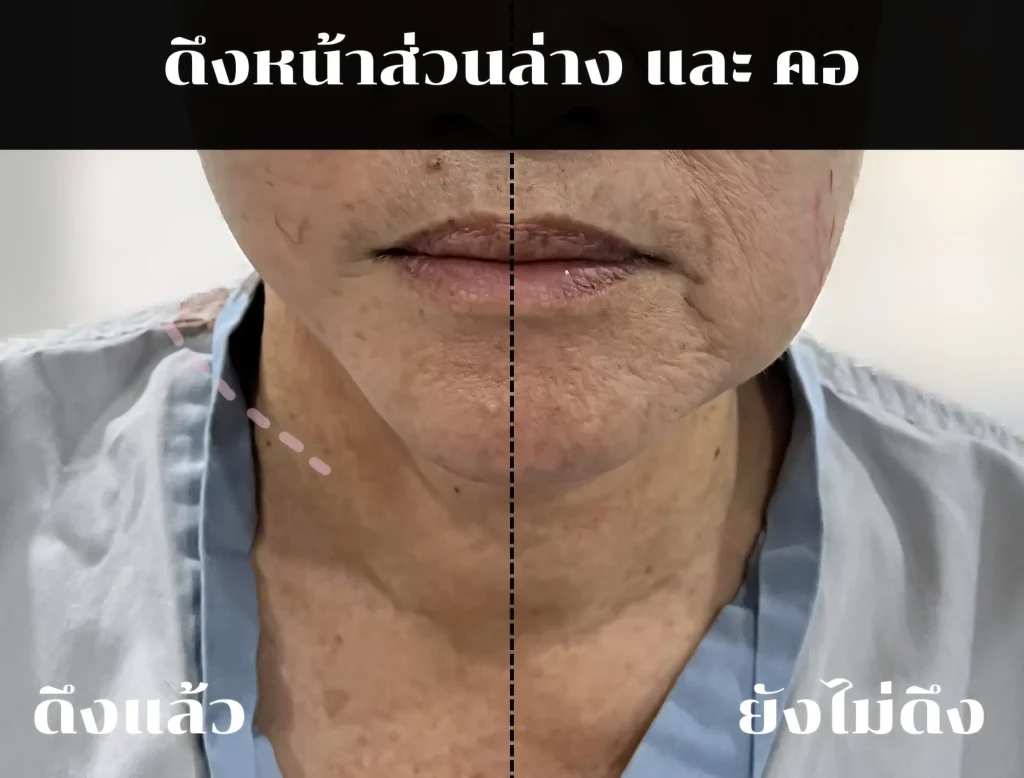 Jaturong ดึงหน้า 2 จุด 9 (Web H)
