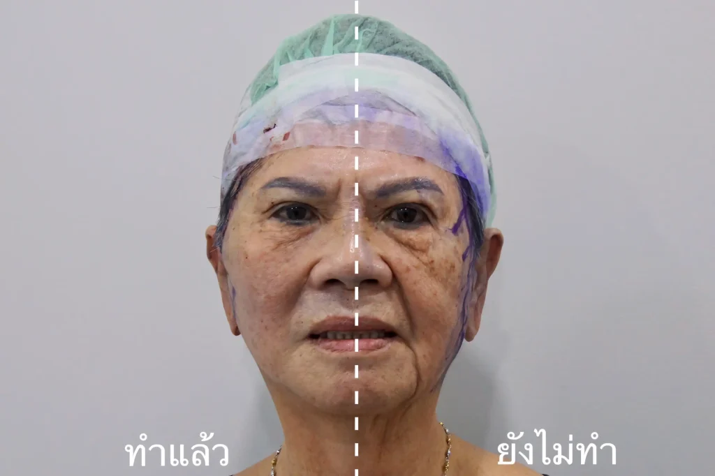 Jaturong ดึงหน้า 3 จุด 1 (Web H)