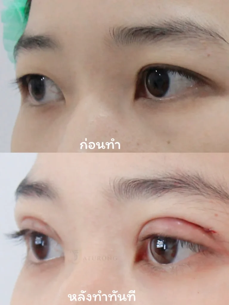 Jaturong ตาสองชั้น 1 (Web V)