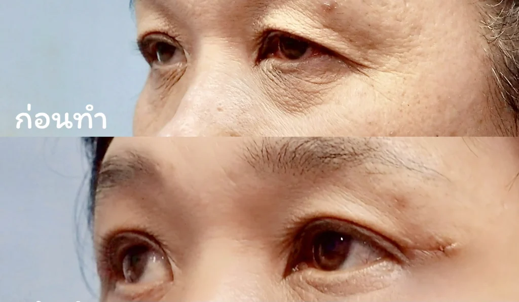 Jaturong ตาสองชั้น 6 (Web H)