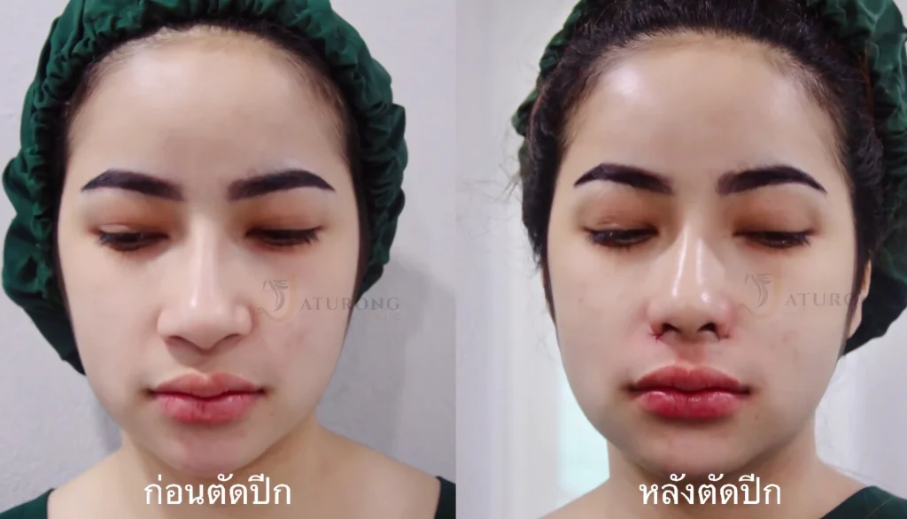 Jaturong ปีกหุบ 2 Web H