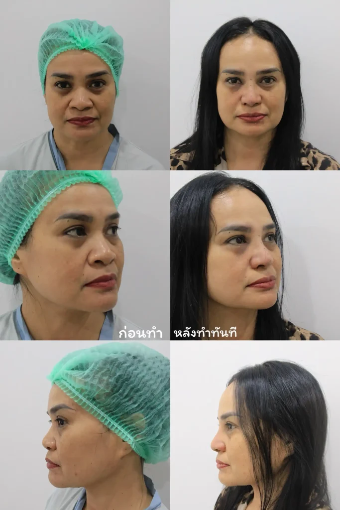 Jaturong ปีกหุบ 6 Web V