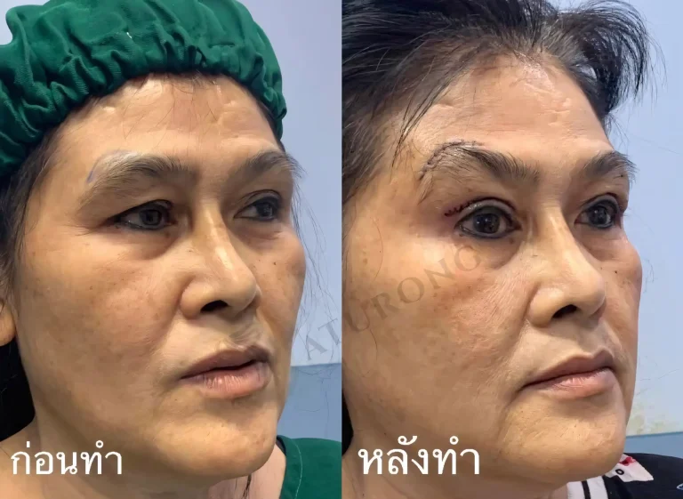 Jaturong ยกคิ้ว 6 Web H