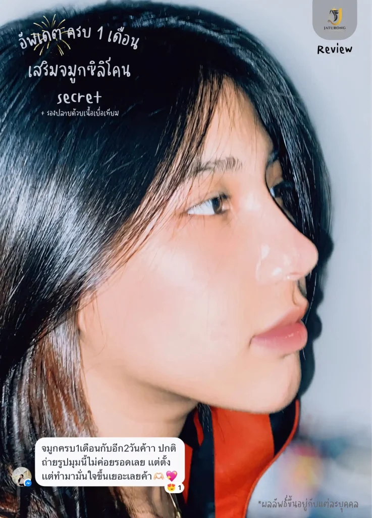 Jaturong เสริมจมูก 14 (Web V)