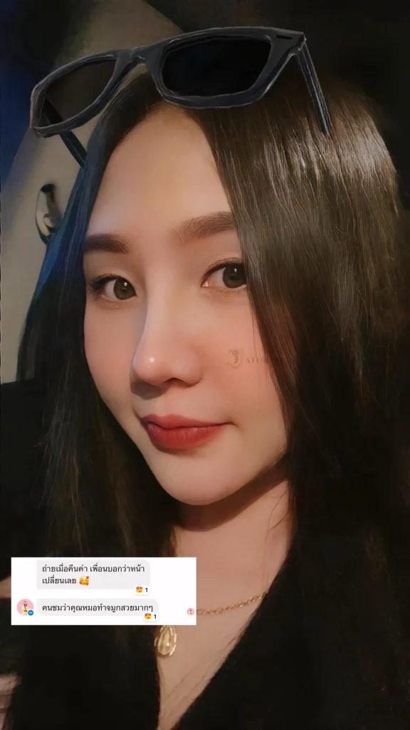 Jaturong เสริมจมูก 16 (Web V)