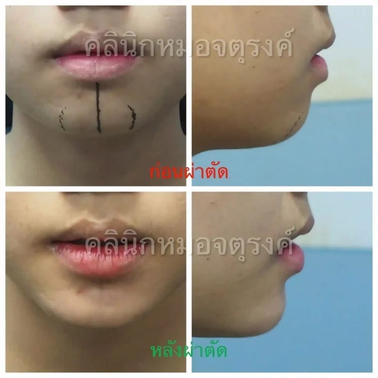 Jaturong แก้คาง 2 Web H