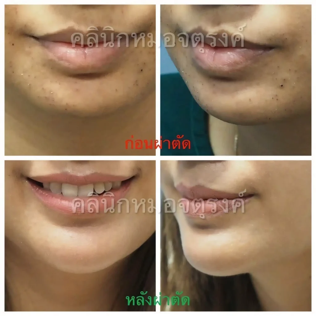 Jaturong แก้คาง 3 Web H