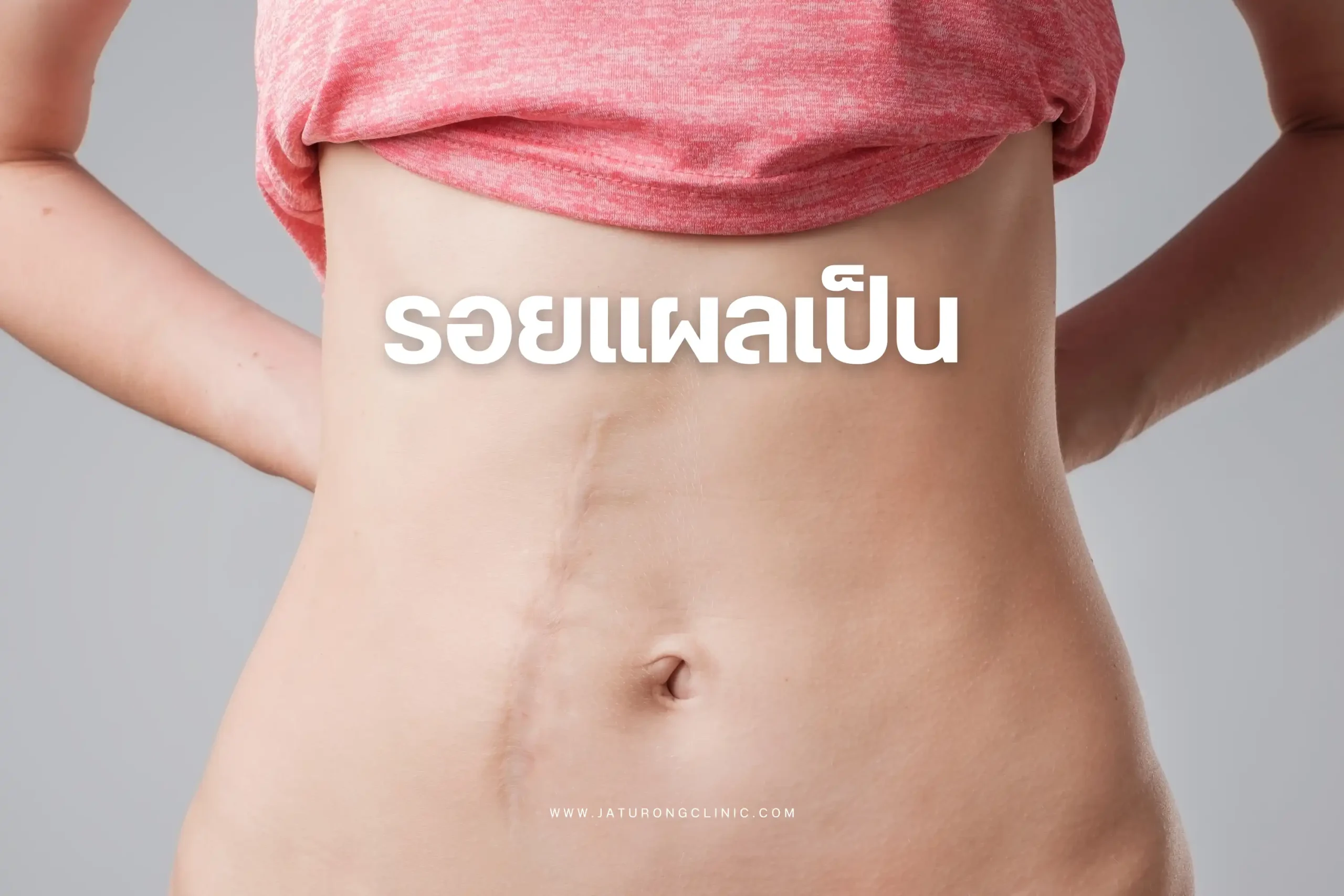 รอยแผลเป็น-cover